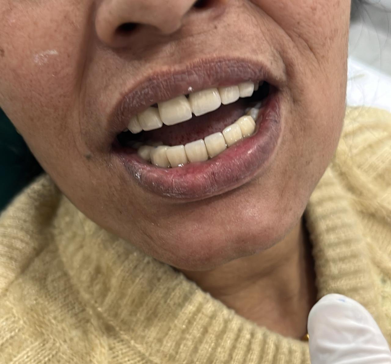Dental Implant After Case 2 - Central Polyclinic